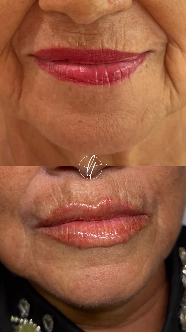 Antes e depois de preenchimento labial — caso 1