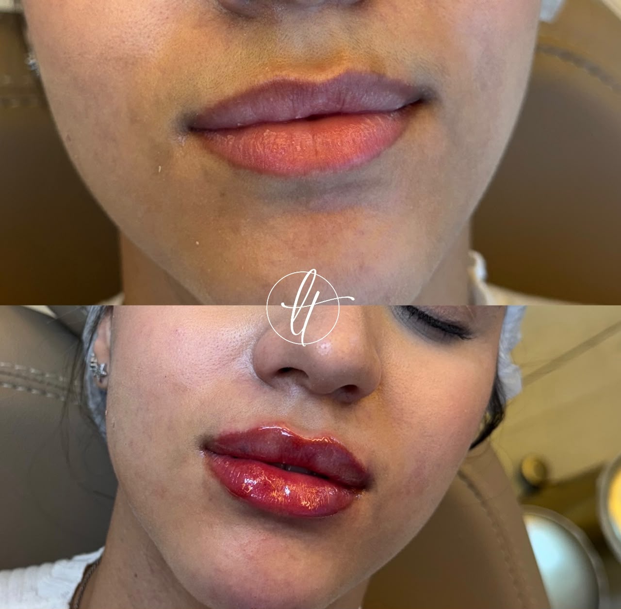 Antes e depois de preenchimento labial — caso 2