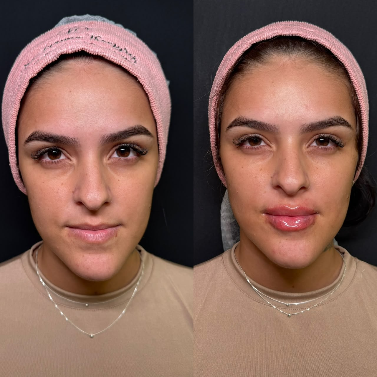 Antes e depois de preenchimento labial — caso 3