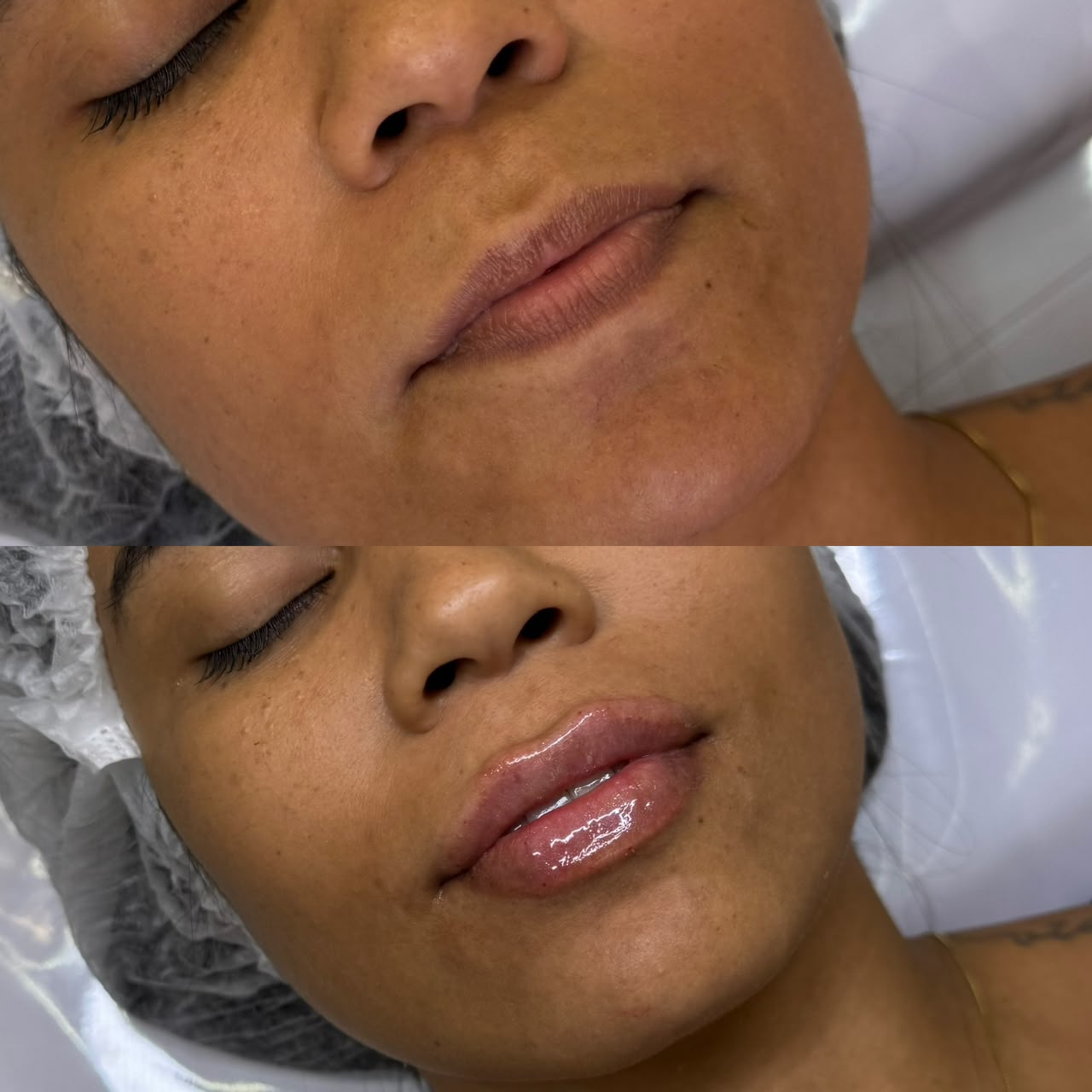 Antes e depois de preenchimento labial — caso 4